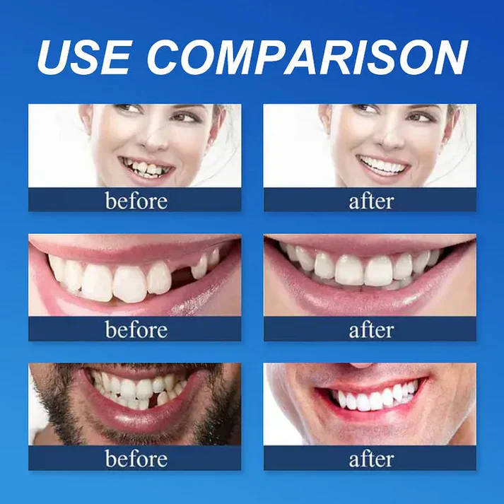 KLENIMORE™ Medical Full Denture with Strong Suctiond Custom-Fit Full Functional Dentures